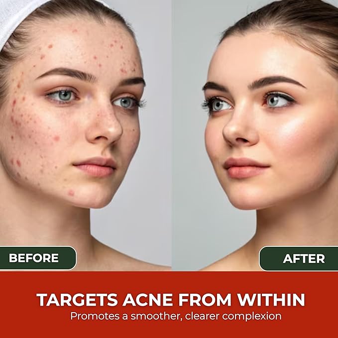 Acne Cleanse Capsules.Powerful Vitex Angus Extract, Niacinamide, Biotin for Teens & Adults. Organic Acne Treatment,Cystic Pimples, Oily Skin to Natural Clear Skin Vitamins Supplement- 60 Count