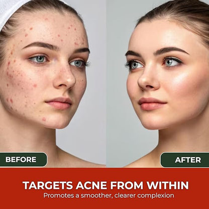 Acne Cleanse Capsules.Powerful Vitex Angus Extract, Niacinamide, Biotin for Teens & Adults. Organic Acne Treatment,Cystic Pimples, Oily Skin to Natural Clear Skin Vitamins Supplement- 60 Count