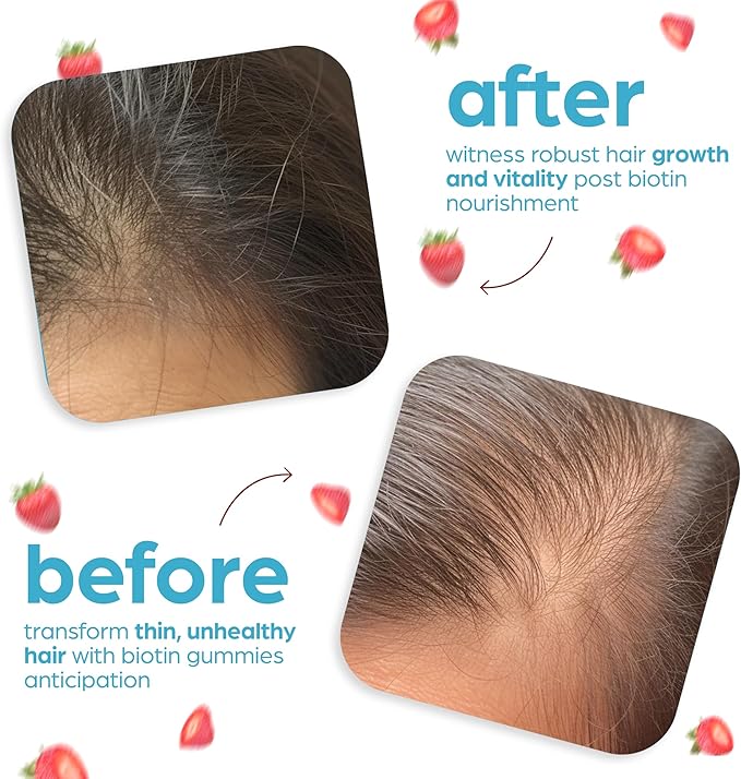 Artnaturals Biotin Gummies for Hair Growth - (100 Gummies - 10000mcg) - Natural Strawberry Vitamins Supports Nails and Skin - Gelatin, Gluten, Nut and Egg Free