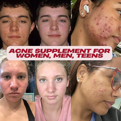 Acne Pills- Vitamin Supplements for Acne Treatment- Natural Clear Skin from Hormonal Cystic Pimples- Oily Skin Vitamins Pill for Women, Teen, Men, & Adults 60 Tablets